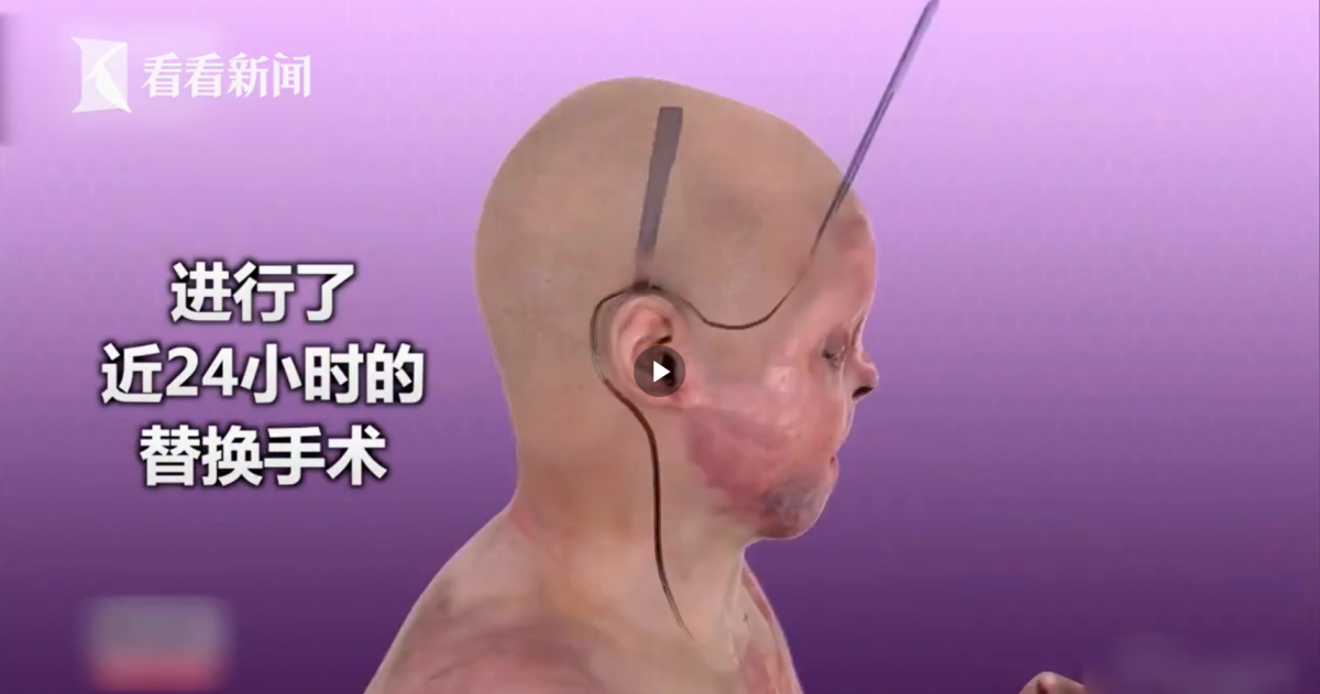 全球首例「換臉換手」手術成功 16個醫生耗時23小時